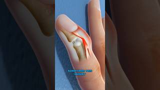 What is mallet finger 3D Animation [upl. by Normac374]