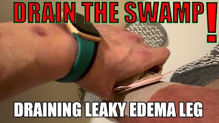 DRAIN THE SWAMP leaky leg edema drainage DIY trick to stay clean and dry w OSTOMY BAG LEFT LEG [upl. by Auqenehs]