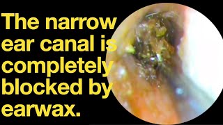 The narrow ear canal is completely blocked by earwaxear wax removal  ear cleaning  ASMR [upl. by Edmunda801]