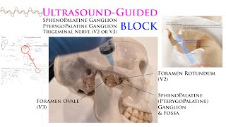 UltrasoundGuided Sphenopalatine Pterygopalatine Trigeminal Nerve Gasserian Ganglion Blocks [upl. by Annoif606]