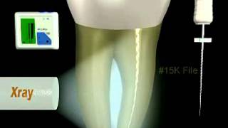 Dental U Files Root Canal Endodontic Files NITI Ultrasonic 15 [upl. by Ahsatam]