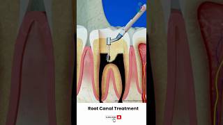 Root Canal Treatment Procedure ↪ 3D Medical Animation Shorts RootCanal Tooth [upl. by Portland]