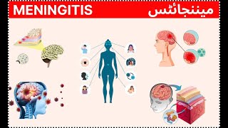 meningitis  mannjites  मेनिंजाइटिस [upl. by Nylhtac]