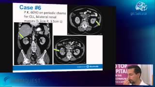 06 Robotic Partial Nephrectomy Challenging scenarios and cases Ronney Abaza HD [upl. by Yelsa]