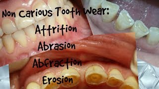 Non Carious Tooth WearAttrition Abrasion Abfraction ErosionClinical Appearance Diagnosis [upl. by Codee108]