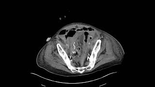 Sigmoid anastomotic dehiscence [upl. by Elbys]