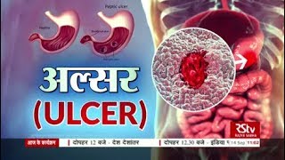 Ayushman Bhava  अल्सर  Ulcer [upl. by Koerlin]