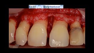 Periodontal Surgery Upper Front Teeth [upl. by Khano]