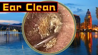 Ear wax removal Cleaning ear wax [upl. by Barri]