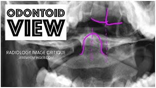 Radiology Image Critique Odontoid View [upl. by Calie]