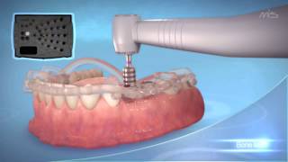 MIS Implants MGUIDE guided Implant placement procedure [upl. by Meaghan]