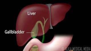 Gallstones and Surgical Removal of Gallbladder Cholecystectomy Animation [upl. by Llertnek]