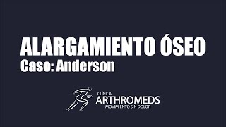 Caso alargamiento óseo  Anderson clínica ARTHROMEDS [upl. by Aisatsana619]