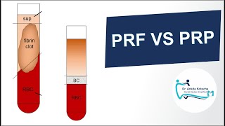 PLATELET RICH PLASMA PRP vs PLATELET RICH FIBRIN PRFSUMMARYPROPERTIESTECHNIQUE DR ANKITA [upl. by Idram]