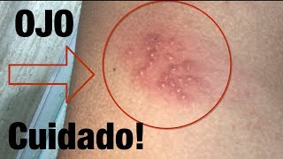 Herpes zoster Sintomas Culebrilla en jovenes [upl. by Anola]