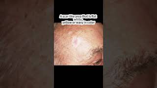 What Does Skin Cancer Look Like Basal Cell Carcinoma [upl. by Morel419]