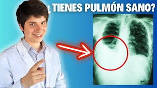 Los SECRETOS del DERRAME PLEURAL en el PULMÓN [upl. by Leahey]