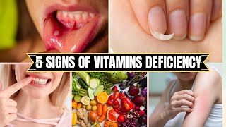 5 Signs of Vitamin Deficiency mouthulcer bleedinggums nails hairloss skinrashes [upl. by Munroe]