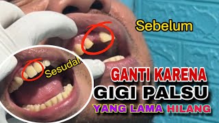 Selama 4 tahun tidak ada masalah ganti baru karena hilang gigi palsu acrylik lepasan [upl. by Rahsab537]