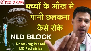 Watering Eyes in Babies  Nasolacrimal Duct Massage  NLD Block Treatment  Dr Anurag Prasad vlog4 [upl. by Attennaj]