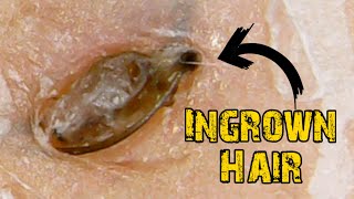 Ingrown Hair Removal x Satisfying Blackheads [upl. by Hanshaw529]