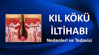 KIL KÖKÜ İLTİHABI Nedenleri ve Tedavisi [upl. by Lissie]