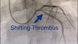 Thrombus Shifts to LCX Acute Anterior MI Cardiogenic Shock Ostial LAD Occlusion How To Treat [upl. by Patty192]