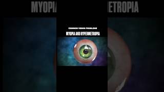 Myopia and Hypermetropia biology neet education [upl. by Maurise612]