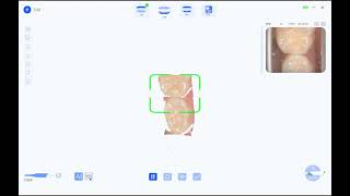 Intraoral Scanner Clinical Real Scan Case Children [upl. by Lorrayne]