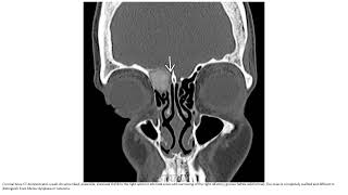 Sinonasal Ossifying Fibroma Imaging [upl. by Emirak]