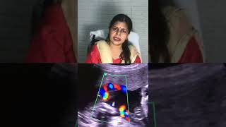 Color Doppler ultrasound in pregnancy  shortvideoDrhome [upl. by Hadihahs]