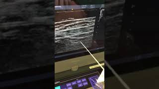 Tap block subcostal approach [upl. by Einon]