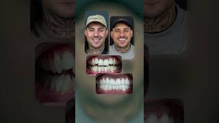 Smile Transformation in Just 5 Days with Zirconium Crowns [upl. by Etteraj]