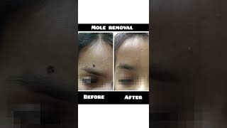 Laser Mole Removal Treatment Benefits [upl. by Noraed281]