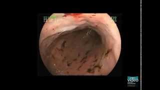 Hemorrhagic Gastropathy [upl. by Efal245]