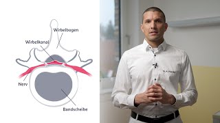 Behandlungsmöglichkeiten der Spinalkanalstenose [upl. by Habas388]