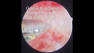 Severe Asherman’s Syndrome – Hysteroscopic Adhesiolysis done By DrPragnesh Shah MD FICOG [upl. by Norton]