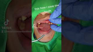 IS ROOT CANAL TREATMENT SAFE [upl. by Htiekel329]