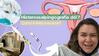 HISTEROSSALPINGOGRAFIA COMO É FEITO [upl. by Anerahs]