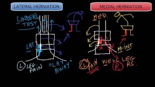 Lateral vs Medial Disc Herniations [upl. by Worth]