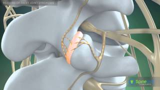 Facet Joint Syndrome Reasons [upl. by Guild]