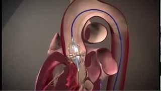 Edwards SAPIEN Transcatheter Heart Valve with the RetroFlex 3 Transfermoral System TAVR [upl. by Gollin]