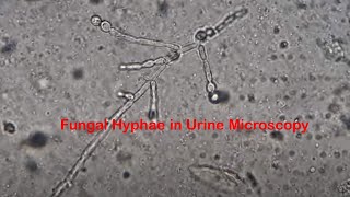 Fungal Hyphae in Urine Microscopy [upl. by Desai]