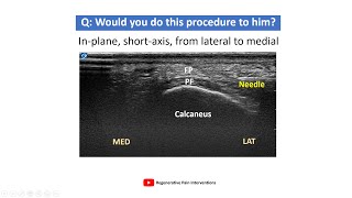 【Pain Hydrodissection series PFFPI】Interface between plantar fascia and plantar fat pad [upl. by Eamon604]