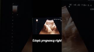 ectopic pregnancy Rt adnexal ring sign [upl. by Nolubez]