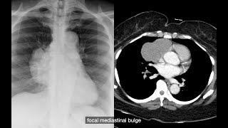 Anterior Mediastinal Disorders in Chest CT  Mass Calcification Fluid Fat [upl. by Diego]