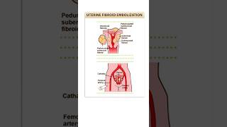 Choose between Myomectomy and Fibroid Embolization youtubeshorts fibroidtreatment shortsfeed2024 [upl. by Eppillihp]