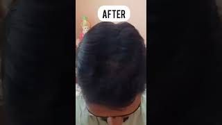 Low Level Laser Light Therapy 🧏‍♀️  Dr Priyanka Reddy  DNA Skin Clinic  skincare [upl. by Kipp913]