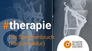 Der Speichenbruch Radiusfraktur  Schön Klinik München Harlaching [upl. by Silda]