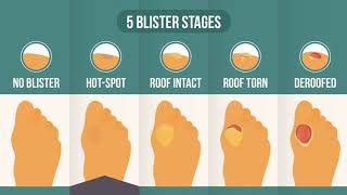 Hot Spot On Foot The 2nd Stage In The 5Stage Blister Process Theory [upl. by Annauqahs]